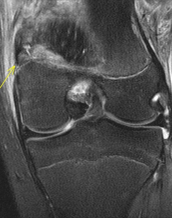 Figure 4 for case Avulsion fracture of the adductor magnus insertion